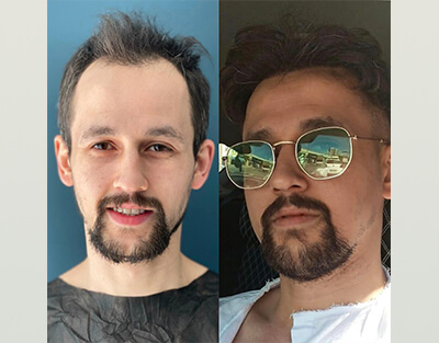 Пересадка волос DHI до и после Результат 4500 Graft